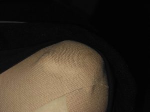 石灰沈着性腱板炎01