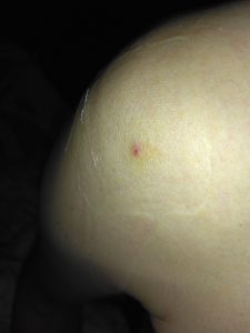 石灰沈着性腱板炎02